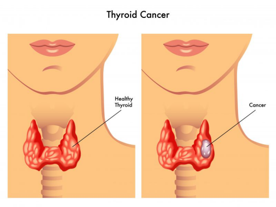 甲状腺疾病怎么治疗